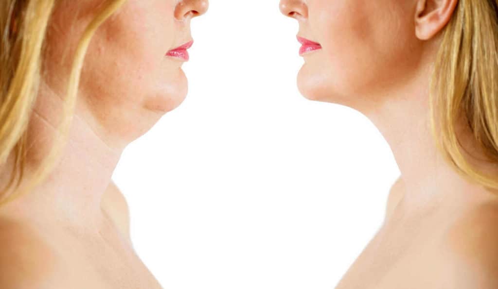Double Chin treatment Banstead before and after results