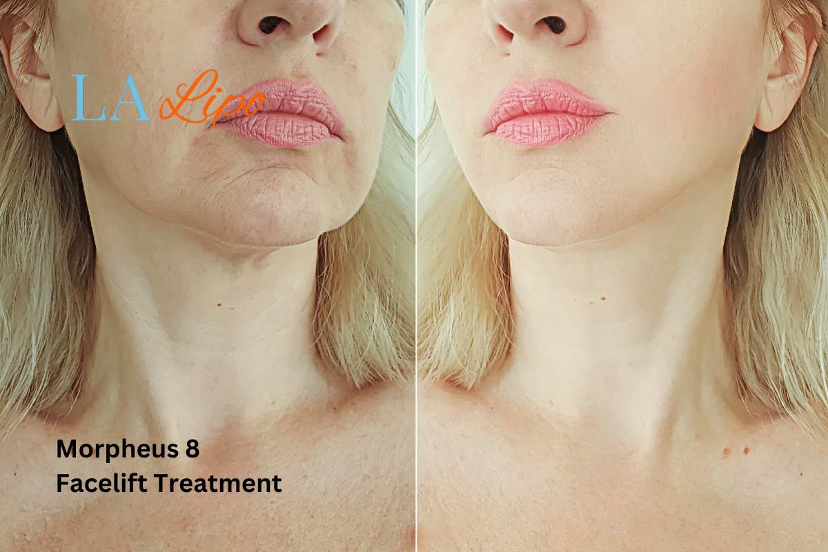 Turn back time with Morpheus8 Treatment Banstead