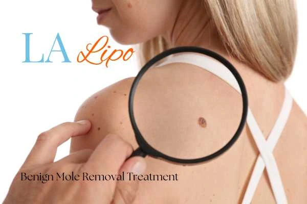 Why getting moles removed Banstead can boost your confidence!