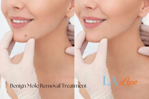 Woman's before and after results of being moles removal treatment Banstead