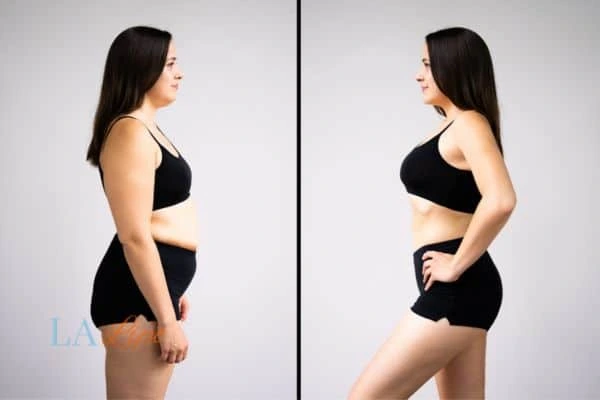 image of woman before and after results of LA-EMS Body Sculpting Banstead to help treat Diastasis recti