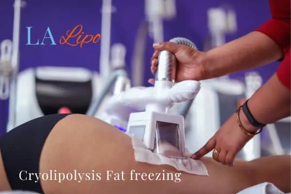 women getting fat freezing Banstead