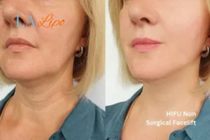 hi-fu for wrinkles Banstead before and after results