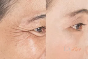 Before and after results of woman - HI-fu wrinkles reduction treatment Banstead