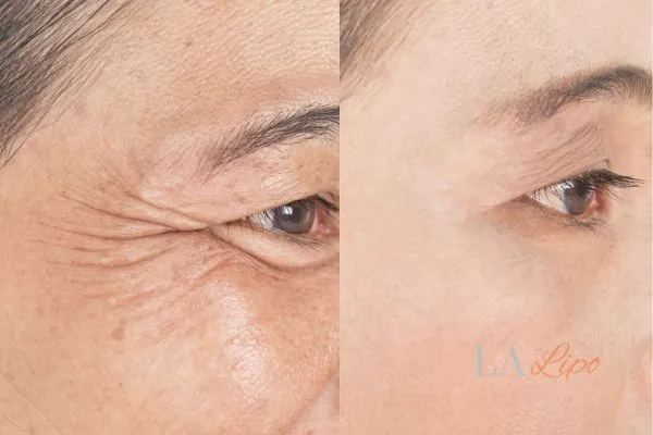 Before and after results of woman - HI-fu wrinkles reduction treatment Banstead