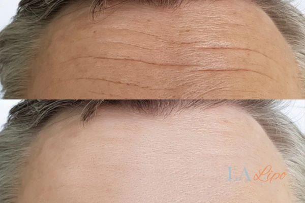results of HIFU Banstead on mans forehead to help reduce lines and wrinkles