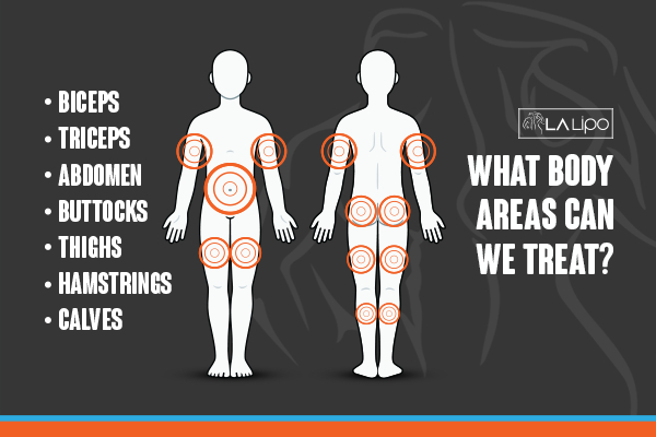 Graphic to show areas you can have LA-EMS Body Sculpting Banstead treatment.
