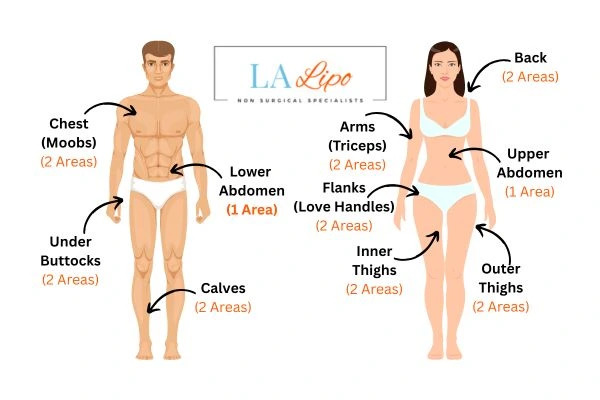 LA LIPO Cryolipolysis Areas Banstead