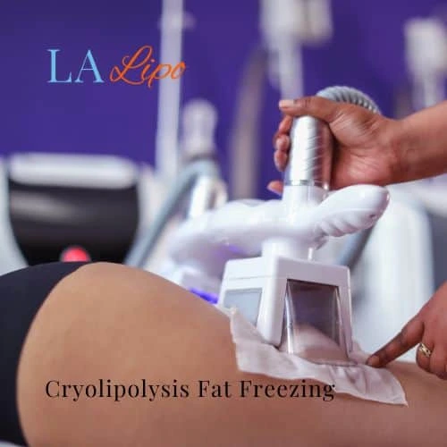 fat freezing - Cryolipolysis Banstead
