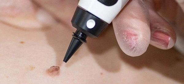 skin tag removal using cryopen Banstead