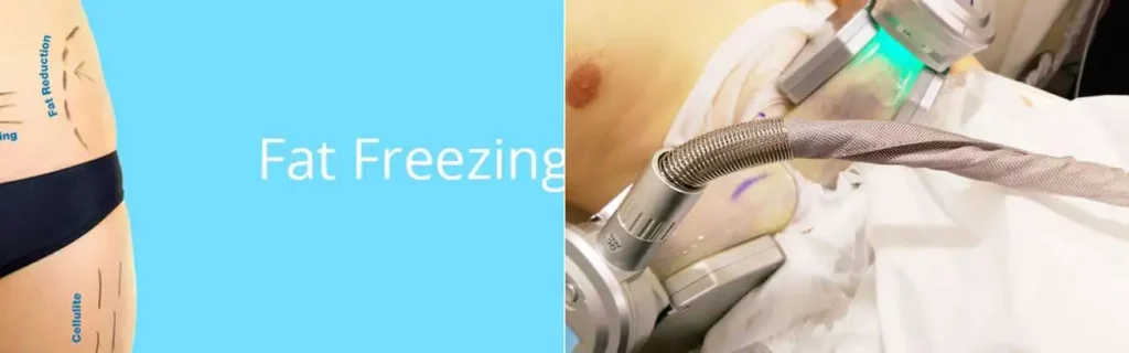 Fat freezing Banstead on multiple areas of the body