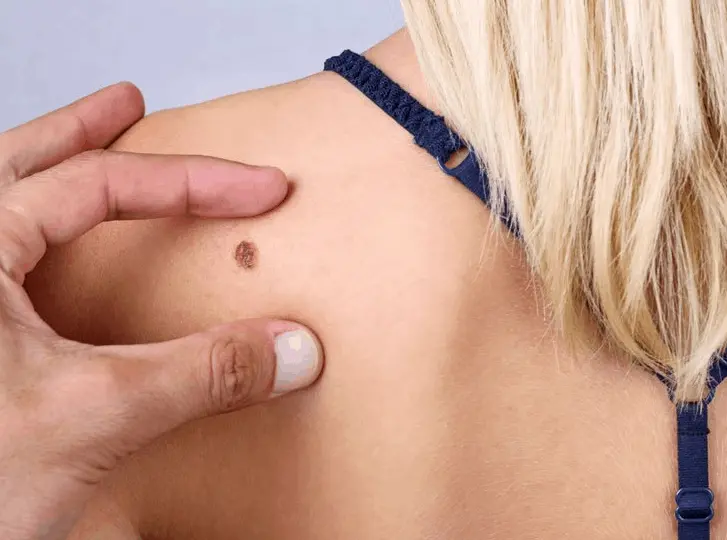 woman having mole removal Banstead consultation before treatment.