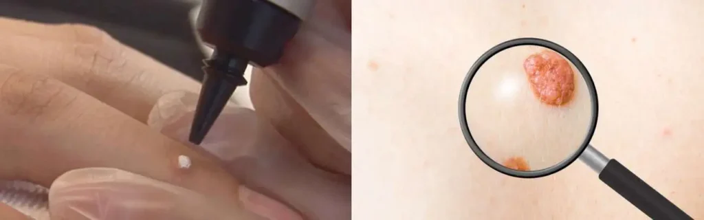 Cryopen for mole removal Banstead - speak to our team today!