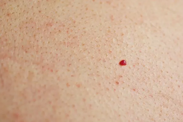close up of a cherry angioma Banstead