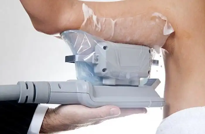 Picture of fat freezing Banstead on the upper arms.