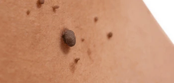image of a skin tag Banstead