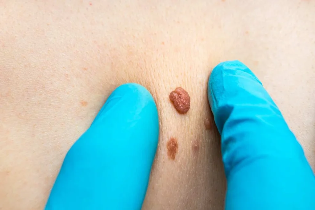 Consultant examining a skin tag Banstead
