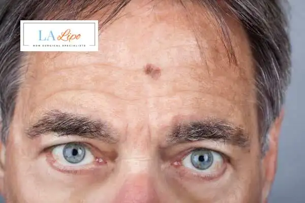 Solar Lentigo Removal Banstead image of man with mark on his forehead