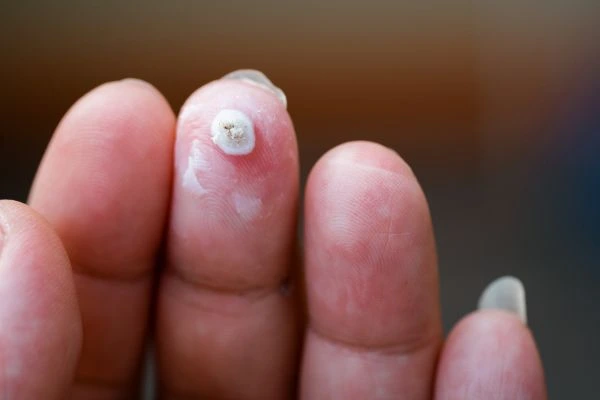 wart on person finger - cryotherapy to treat from LA LIPO Banstead
