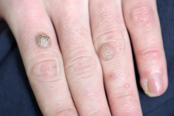 photo of warts on person hand - see wart removal Banstead from LA LIPO