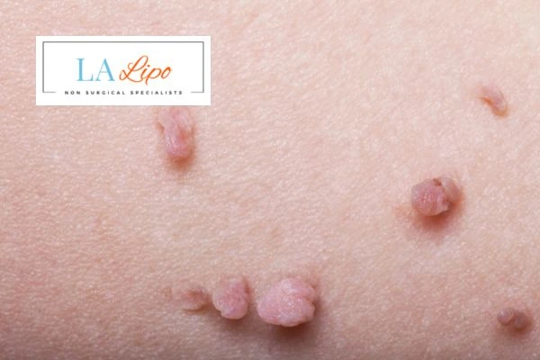 Does cryopen skin tag removal Banstead hurt? Find out now call our team today!