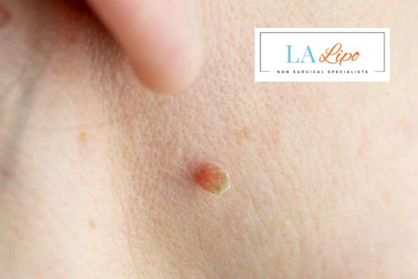 Book skin tag removal Banstead today speak to our team now!
