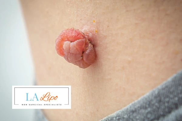 Interested in skin tag removal Banstead? Concerned about the pain? Find out more today!