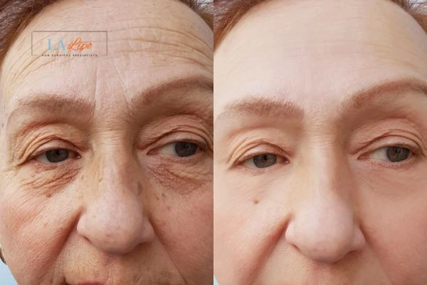 The powerful benefits of Morpheus8 Treatment Banstead - Call Our team today!