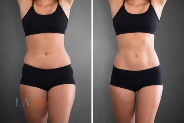 before and after results of non-surgical treatment to help a woman's body image and mental health Banstead