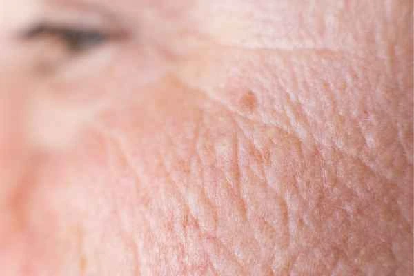 close up picture of a woman's face showing an age spot Banstead