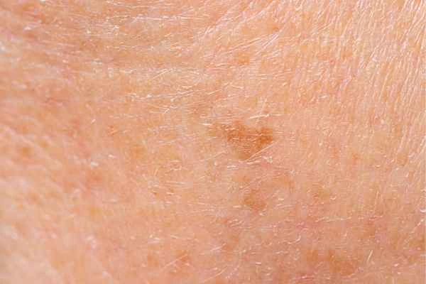close up picture of age spots Banstead