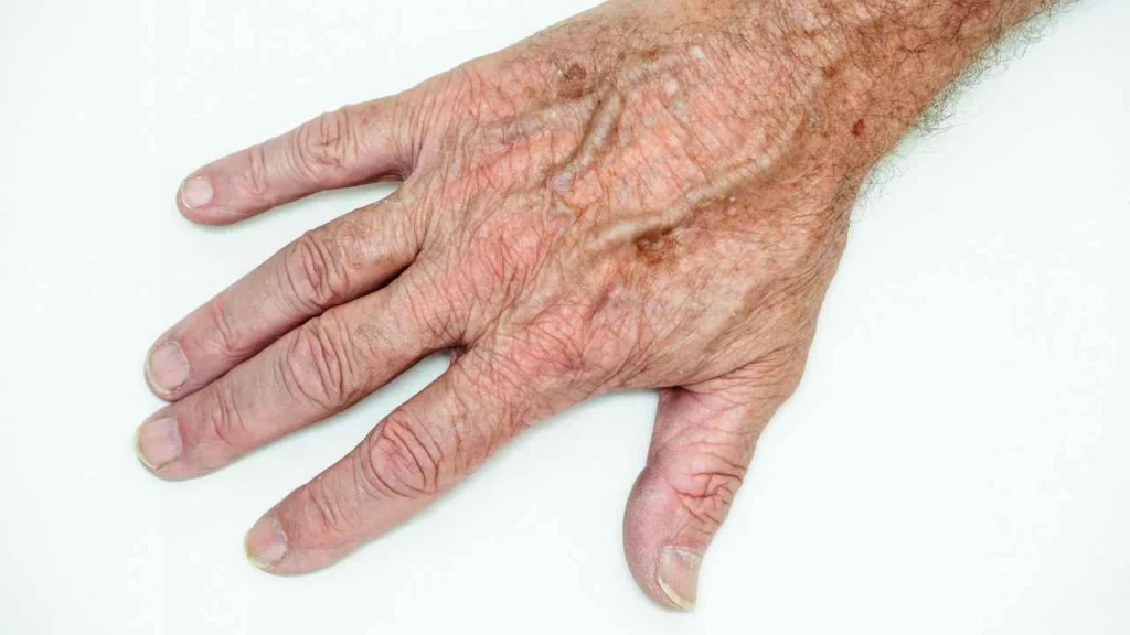 Male hand showing age spot Banstead