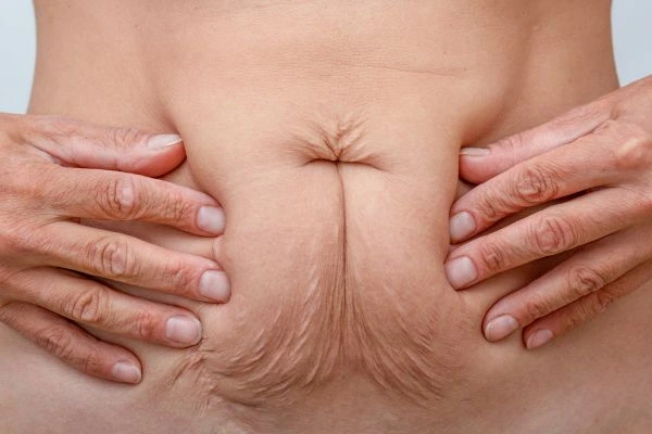 Image of a woman's stomach with loose skin - example of skin tightening Banstead options