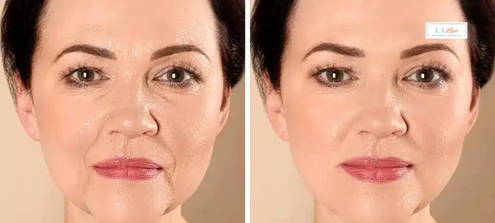 How Long Does It Take to See Results and How Long Do They Last Banstead?